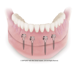 mdi_mandible_2